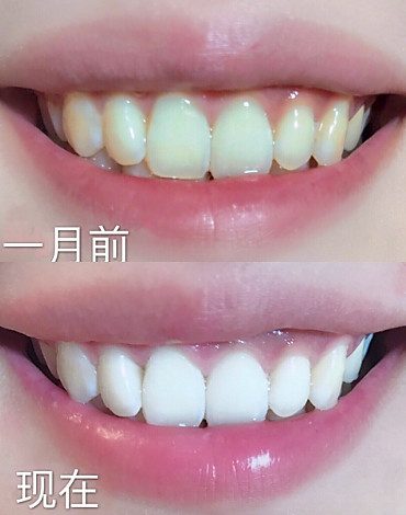 不伤牙齿❗️三个步骤❗️超低成本牙齿美白方法❗️图1